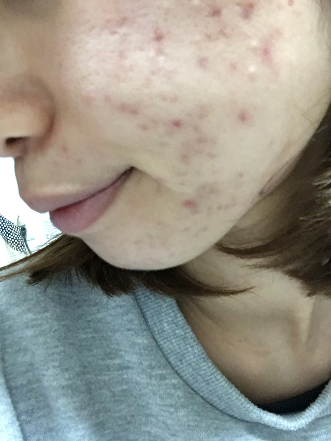 口罩痘 敏感肌 痘肌 脫妝 浮粉 礦物蜜粉 礦物粉底