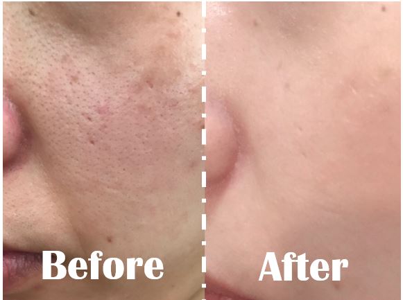 口罩痘 敏感肌 痘肌 脫妝 浮粉 礦物蜜粉 礦物粉底 曠世綺肌