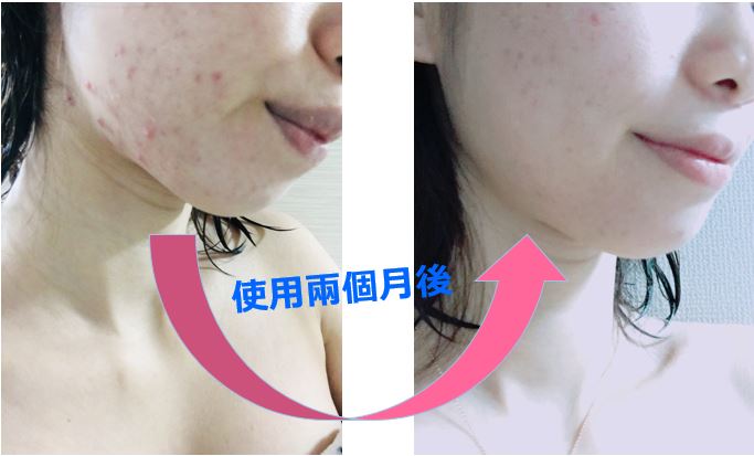 口罩痘 敏感肌 痘肌 脫妝 浮粉 礦物蜜粉 礦物粉底 曠世綺肌