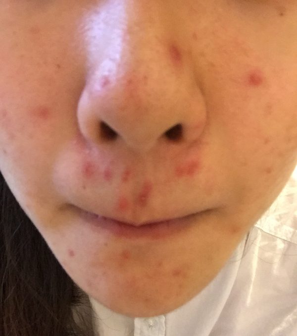 口罩痘 敏感肌 痘肌 脫妝 浮粉 礦物蜜粉 礦物粉底