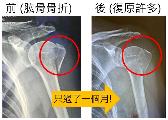 一個月後的復原狀況